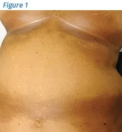 Generalized Morphea Trunk - Figure 1